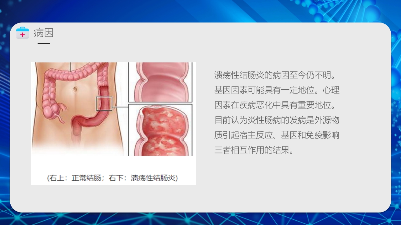 溃疡性结肠炎护理业务PPT课件5