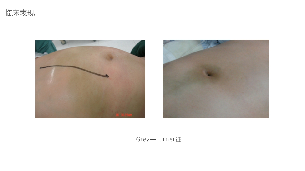 急性胰腺炎护理业务学习PPT课件17