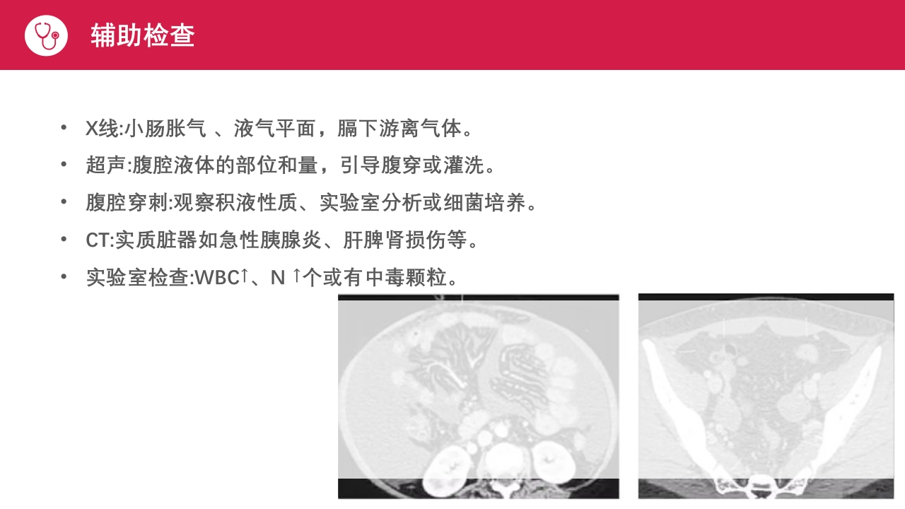 急性腹膜炎患者护理查房PPT课件13