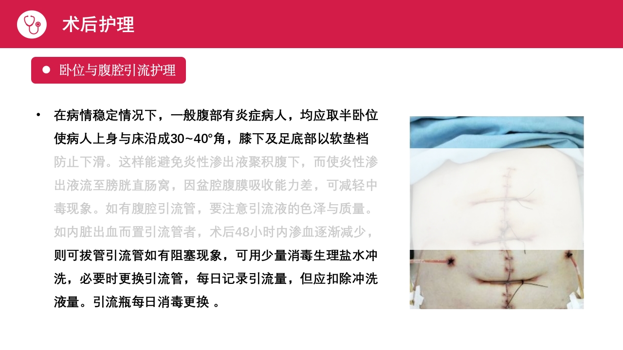 急性腹膜炎患者护理查房PPT课件21