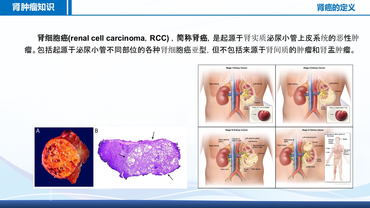 腹腔镜肾部分切除术护理查房PPT课件4
