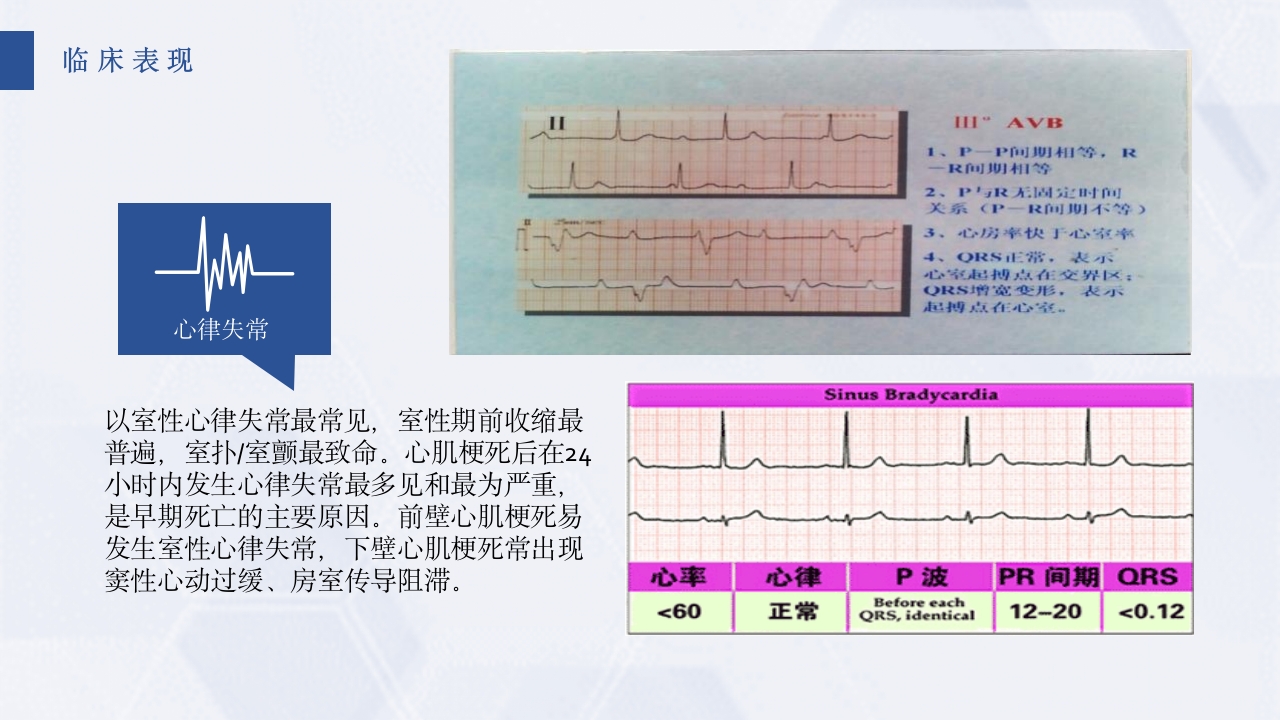 急性心梗护理查房PPT课件20