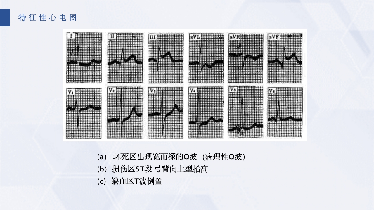 急性心梗护理查房PPT课件23