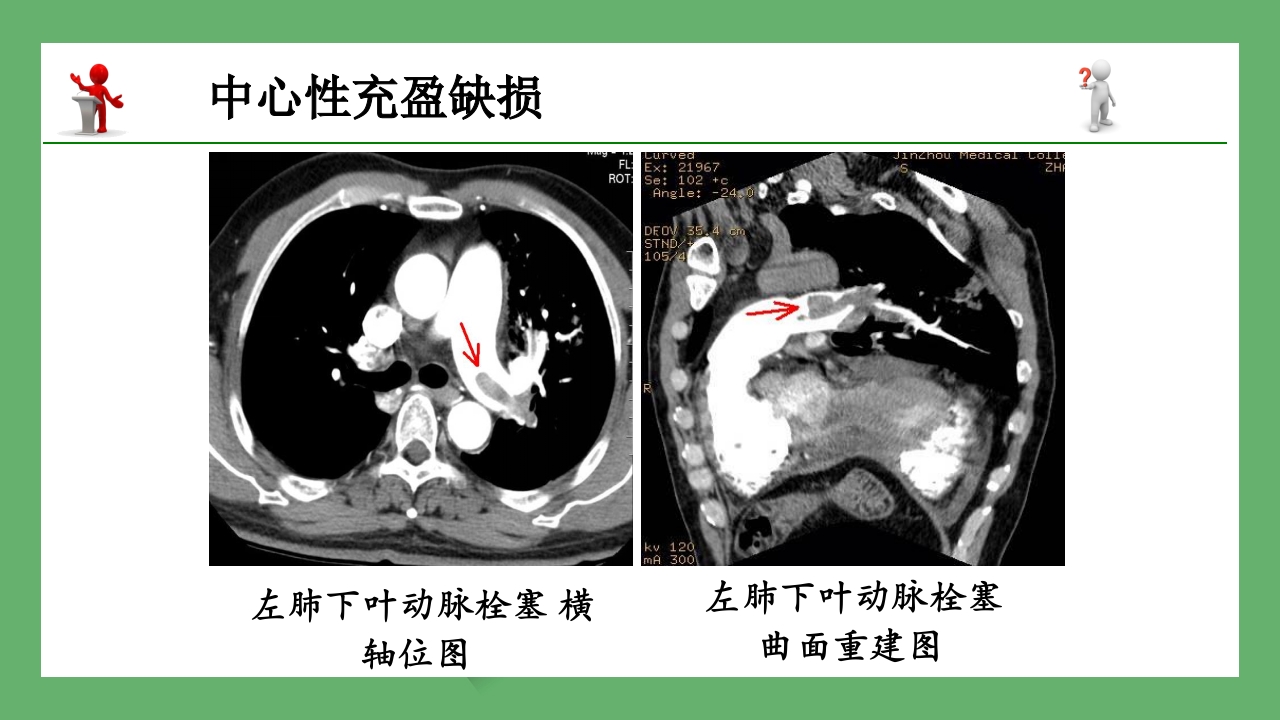 急性肺栓塞的CT表现PPT课件 11