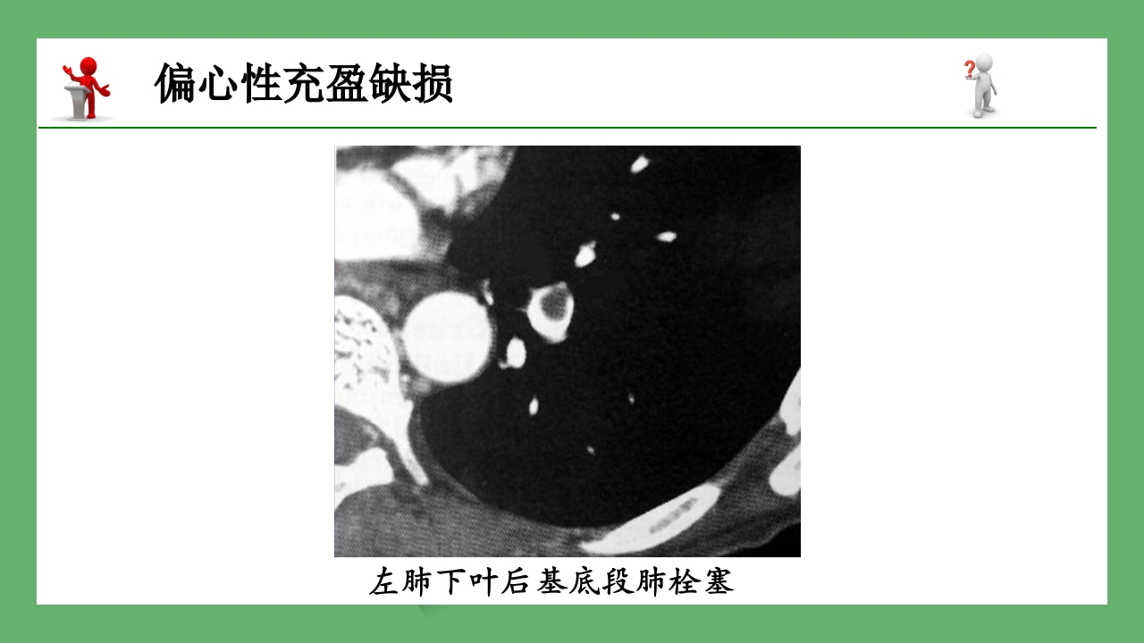 急性肺栓塞的CT表现PPT课件 12