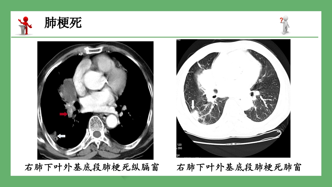 急性肺栓塞的CT表现PPT课件 17