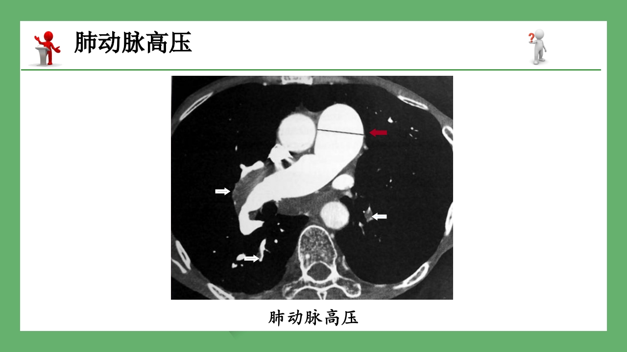 急性肺栓塞的CT表现PPT课件 18