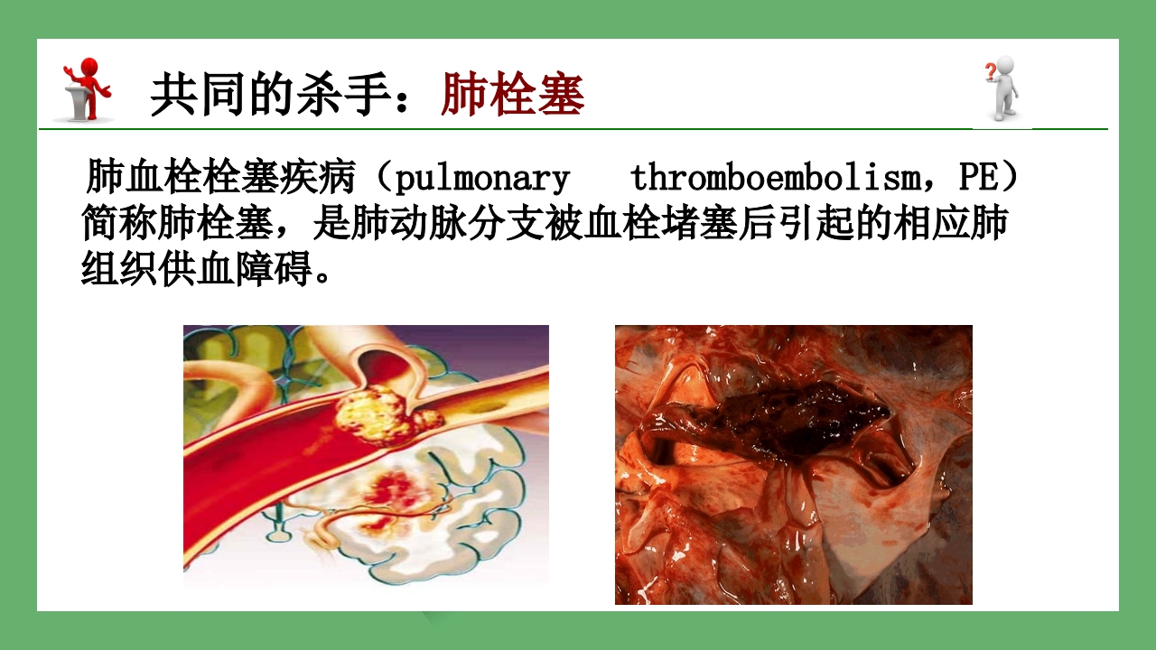 急性肺栓塞的CT表现PPT课件 4