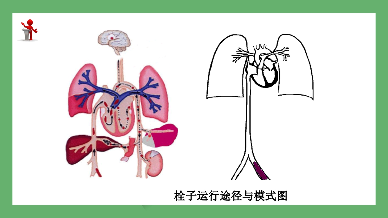 急性肺栓塞的CT表现PPT课件 6