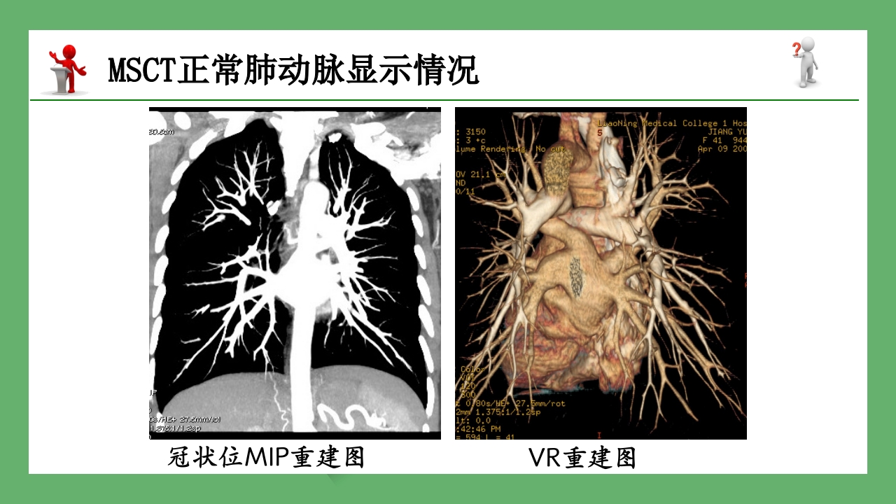 急性肺栓塞的CT表现PPT课件 9