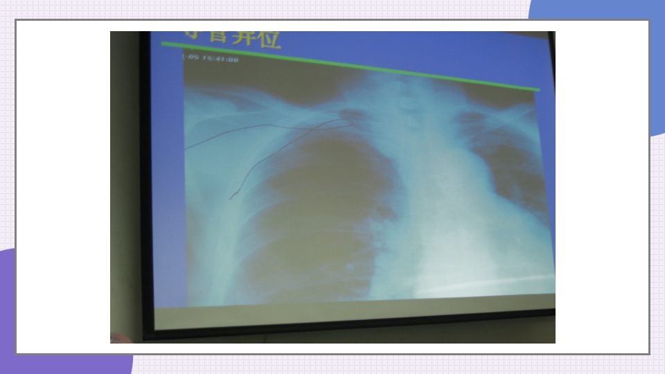中心静脉导管简介和维护PPT课件21