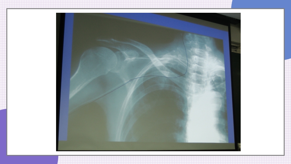 中心静脉导管简介和维护PPT课件24