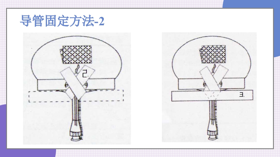 中心静脉导管简介和维护PPT课件39