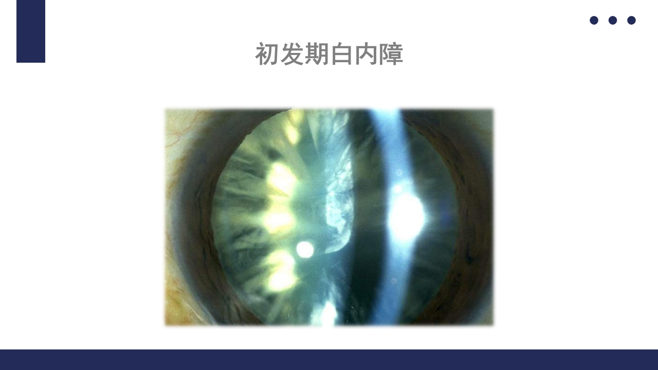 白内障护理教学查房PPT课件17