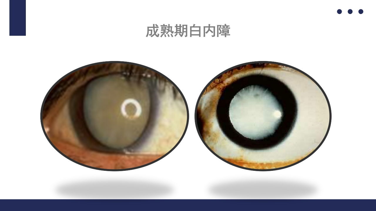 白内障护理教学查房PPT课件21