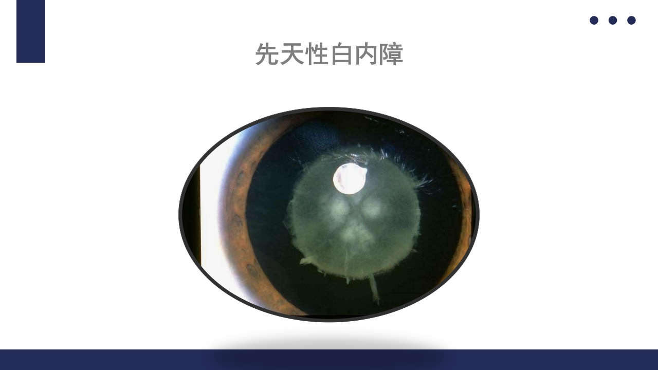 白内障护理教学查房PPT课件29