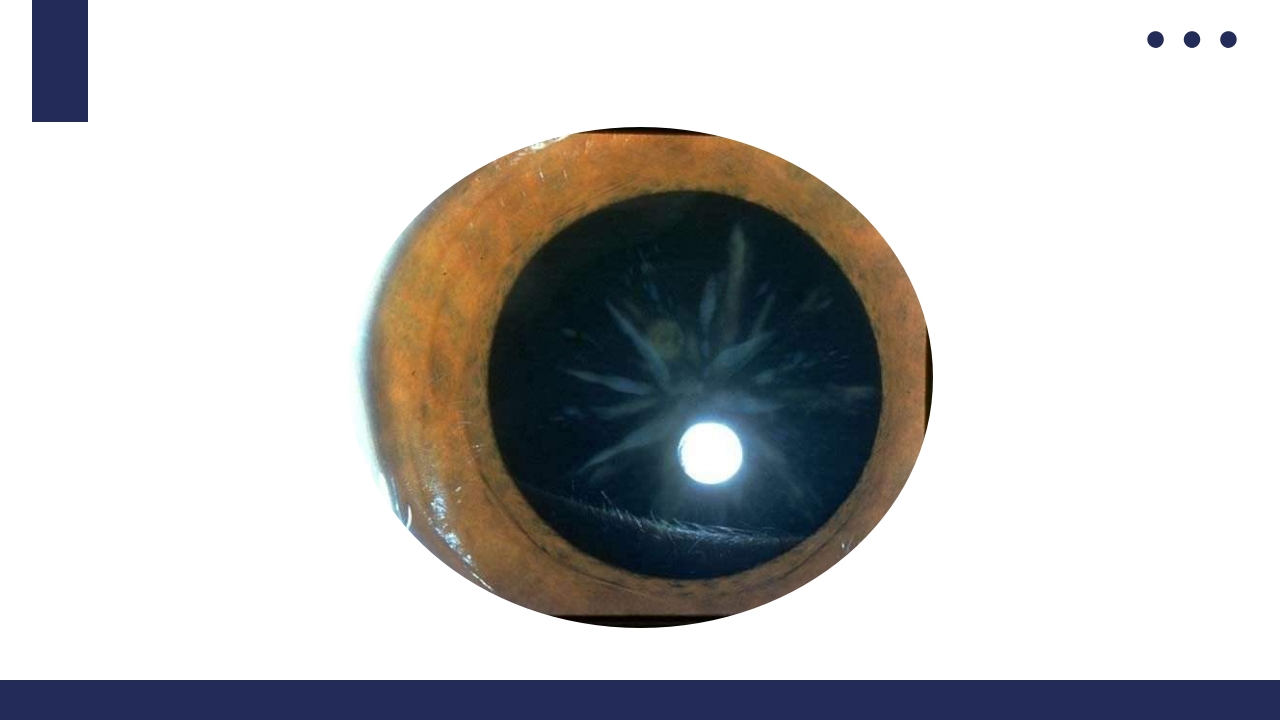 白内障护理教学查房PPT课件32