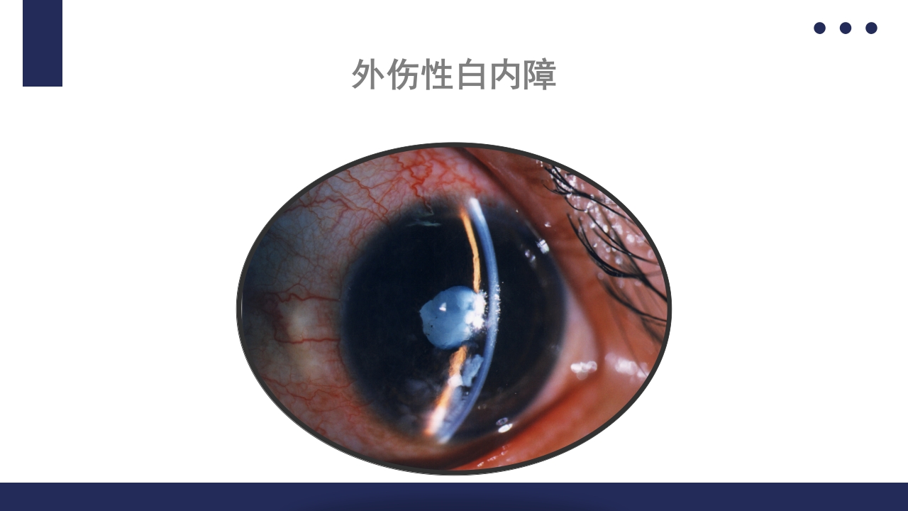 白内障护理教学查房PPT课件35