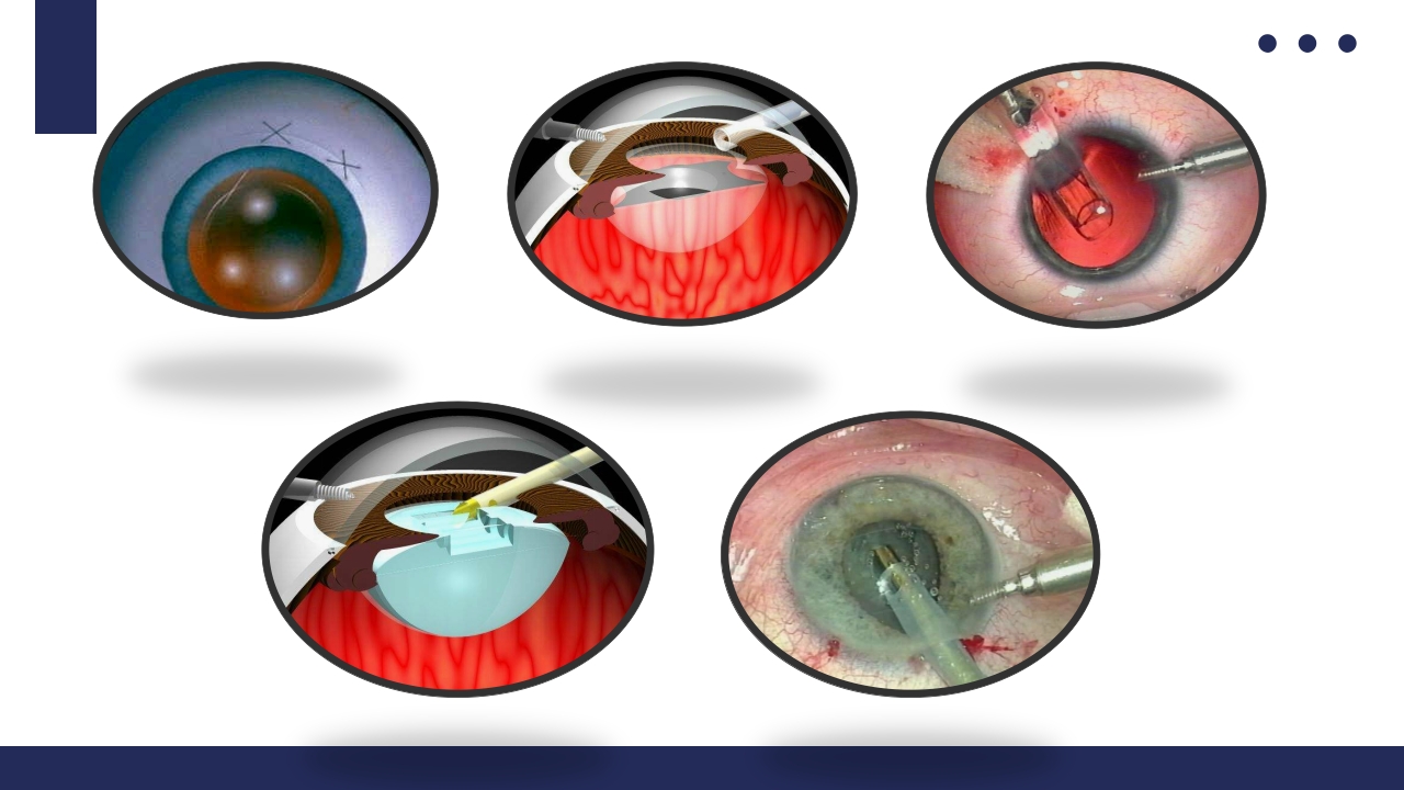 白内障护理教学查房PPT课件47