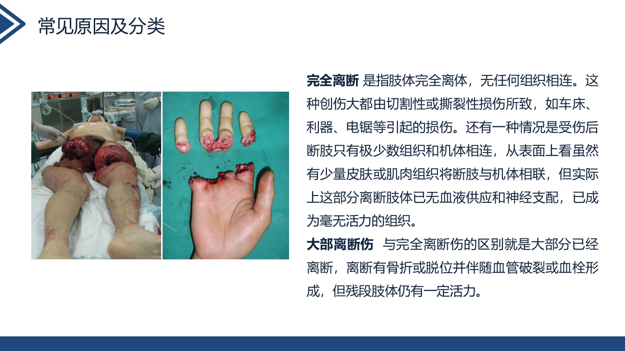 肢体离断伤的护理查房PPT课件5