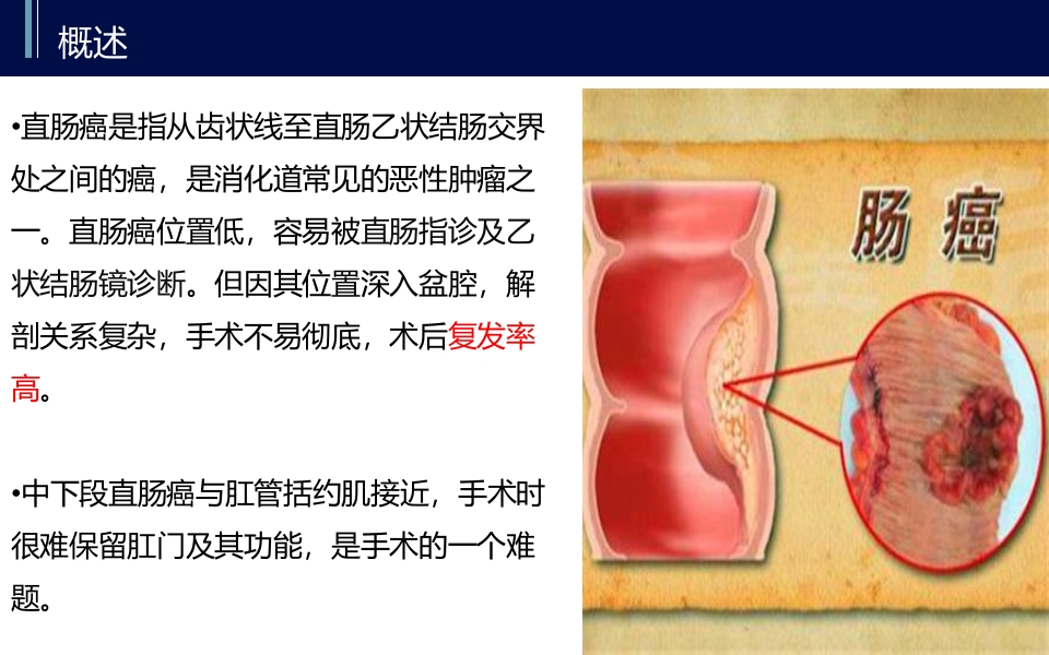 直肠癌PBL护理查房PPT课件13