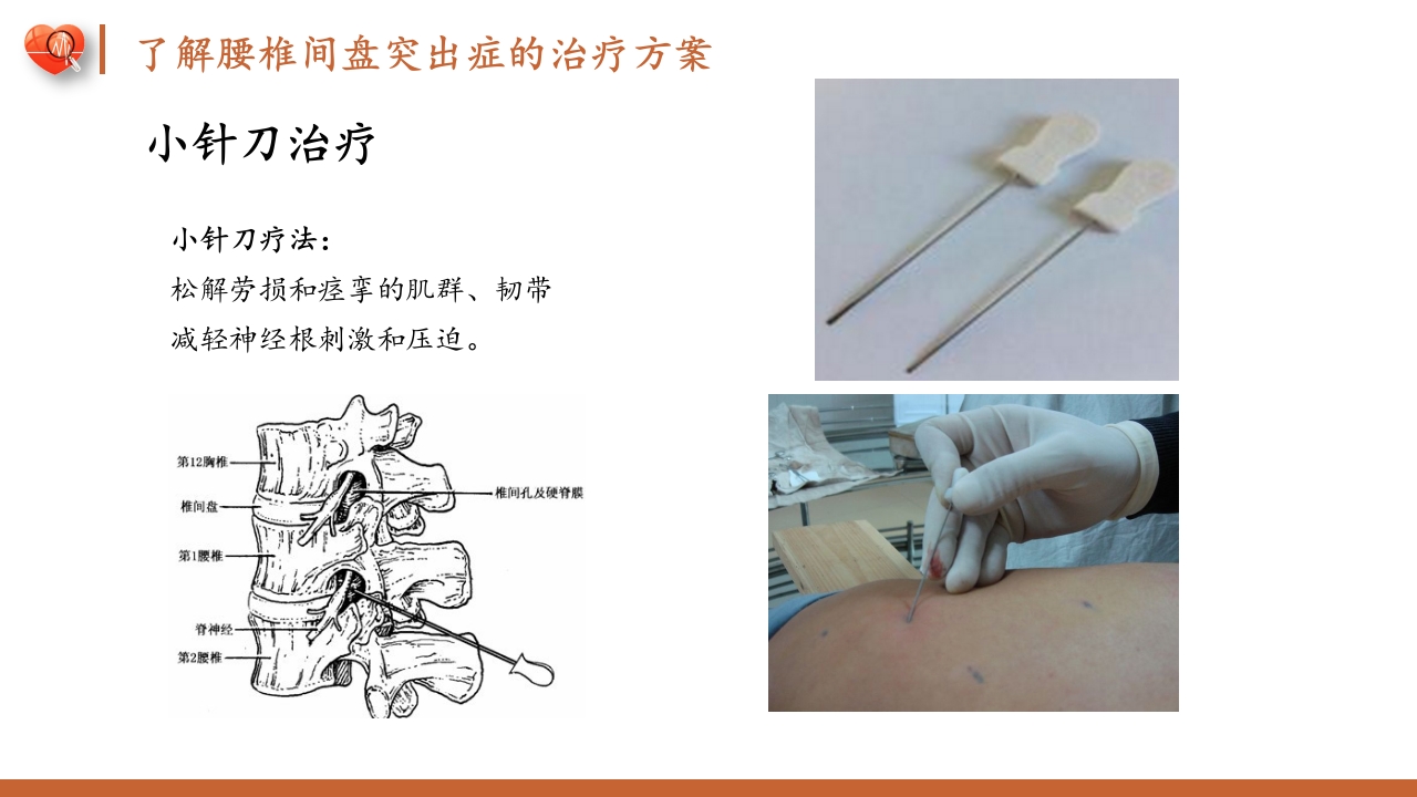 腰椎间盘突出症护理查房健康教育PPT课件11