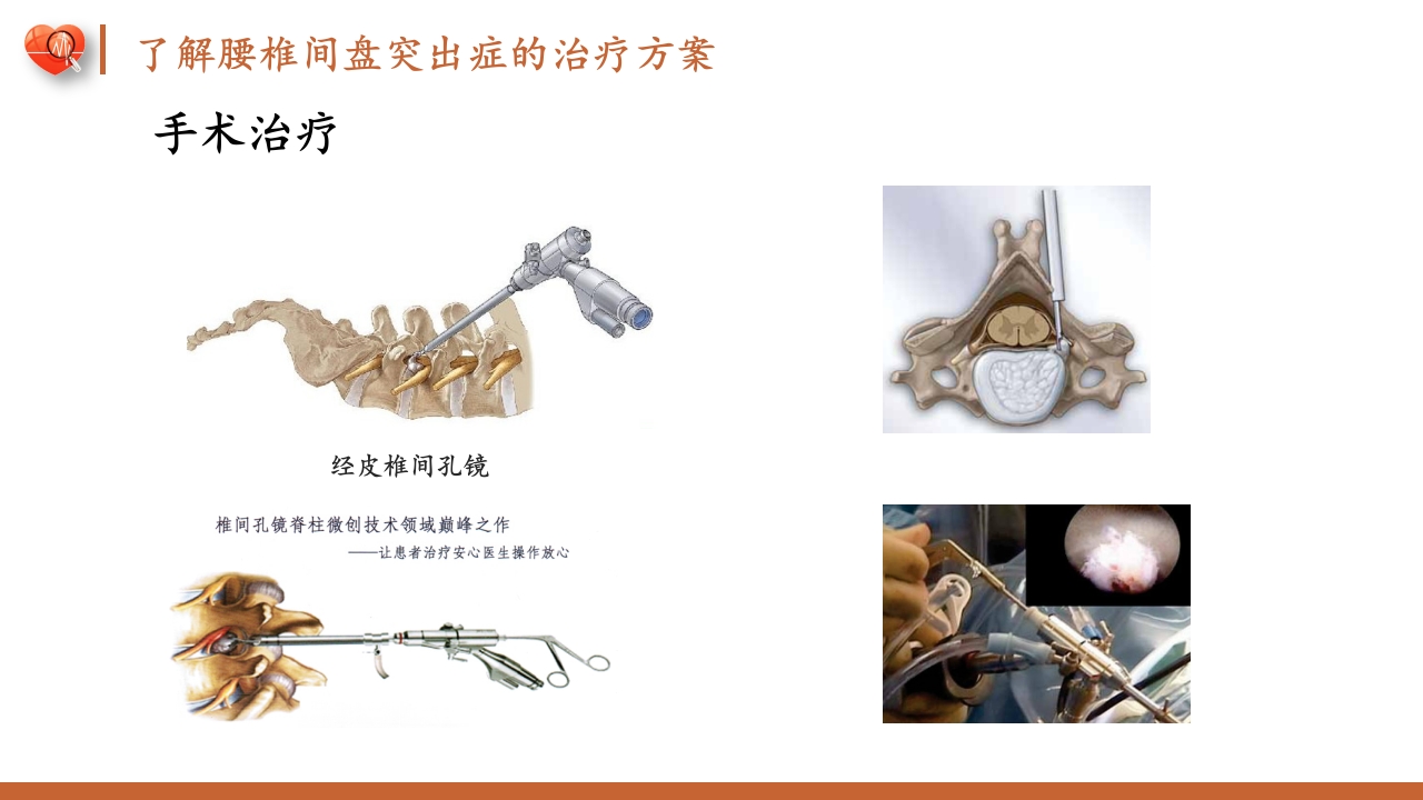 腰椎间盘突出症护理查房健康教育PPT课件16