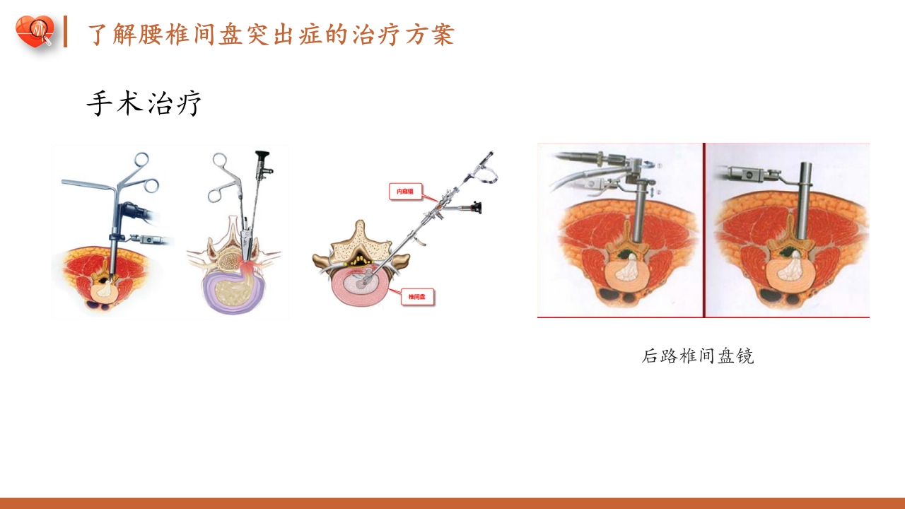 腰椎间盘突出症护理查房健康教育PPT课件17