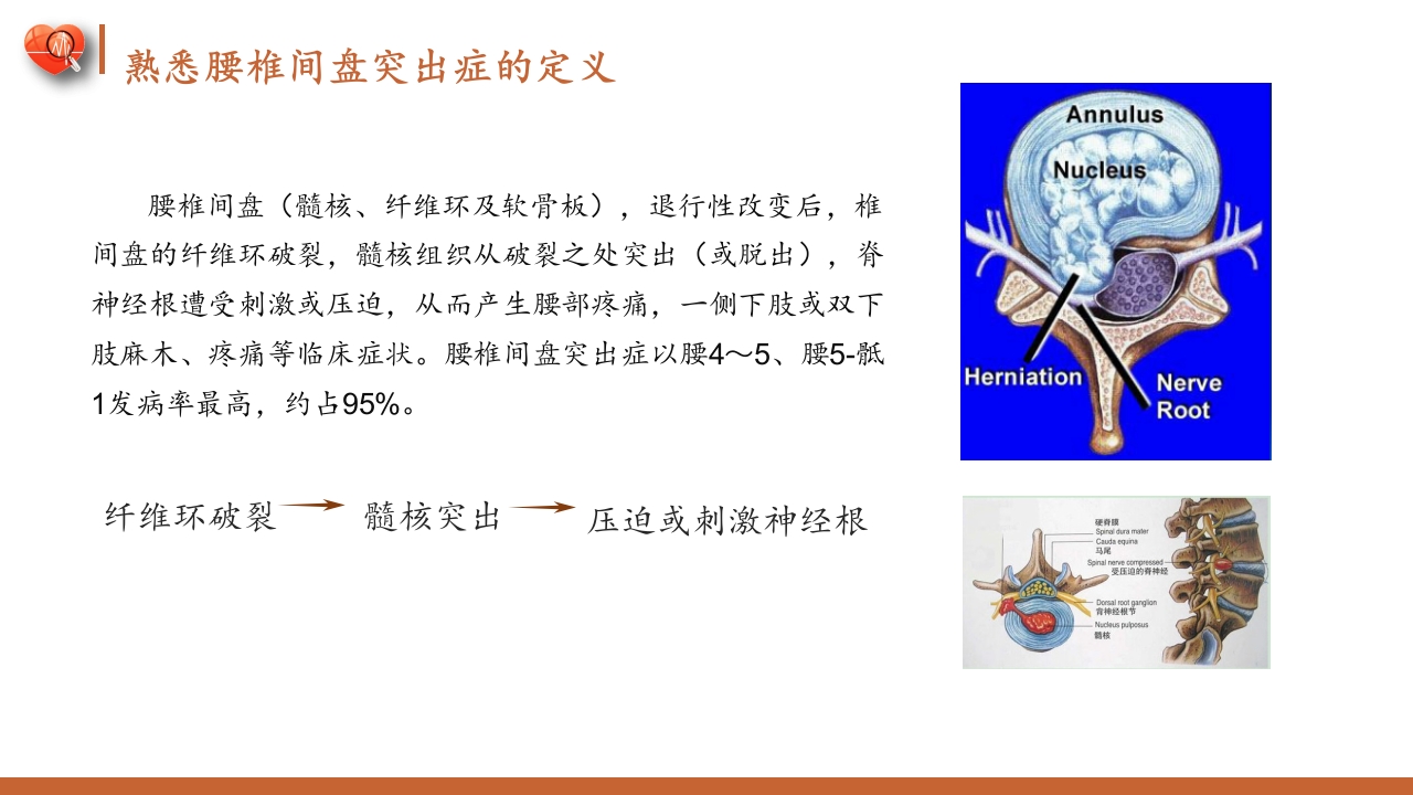 腰椎间盘突出症护理查房健康教育PPT课件3