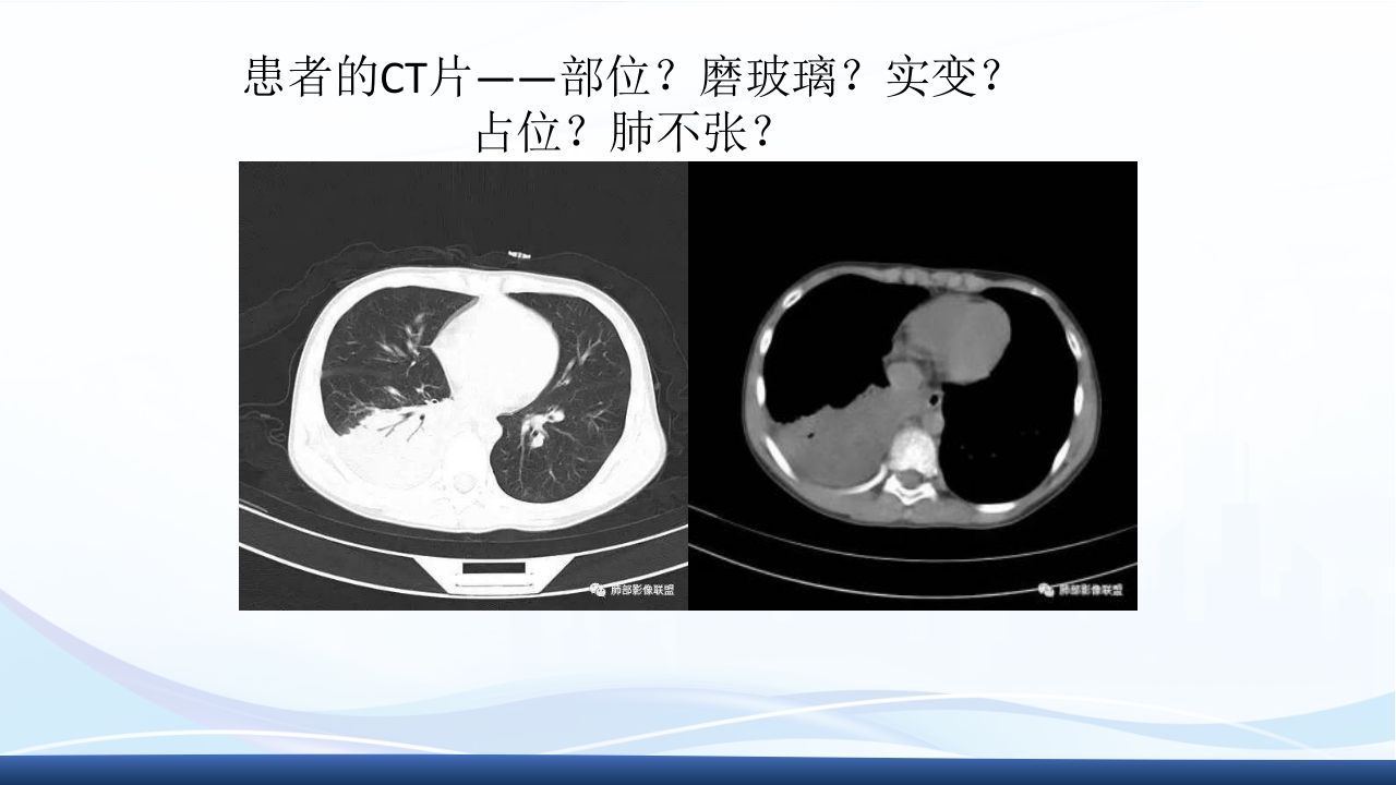 社区获得性肺炎教学查房PPT课件21