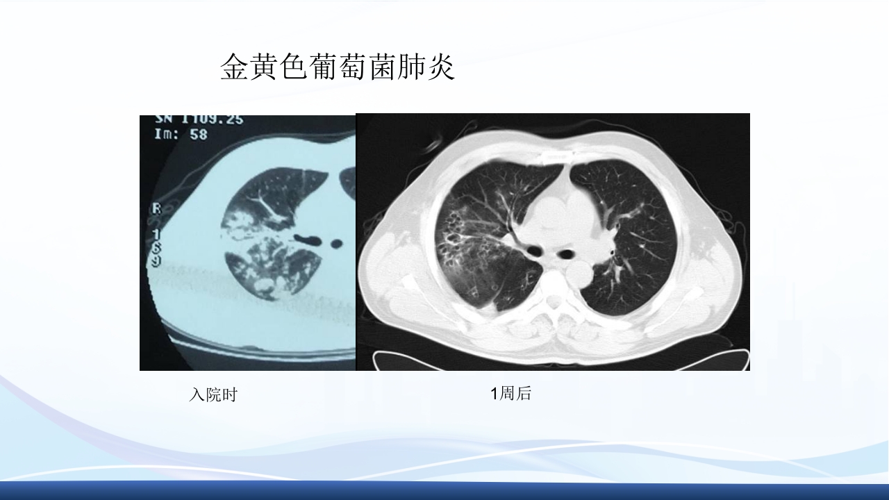 社区获得性肺炎教学查房PPT课件32