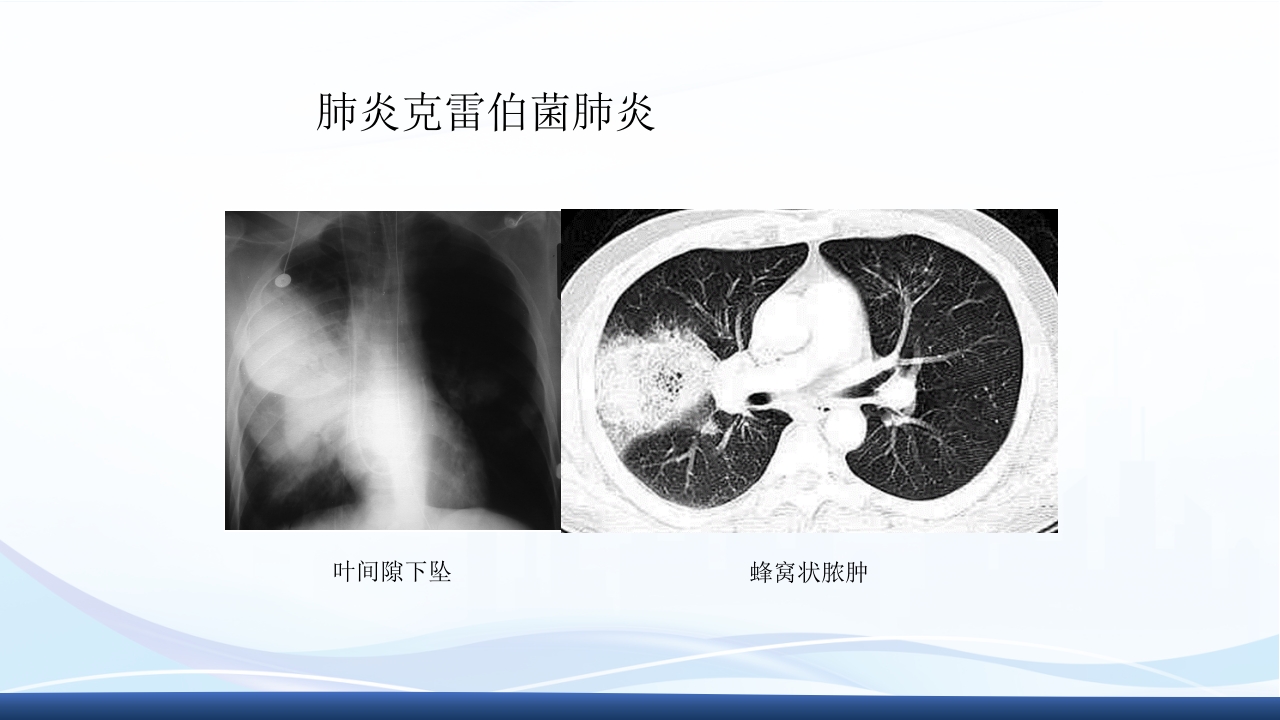 社区获得性肺炎教学查房PPT课件33