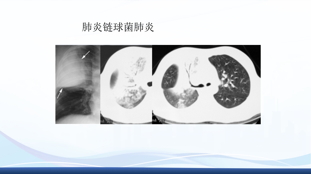 社区获得性肺炎教学查房PPT课件34