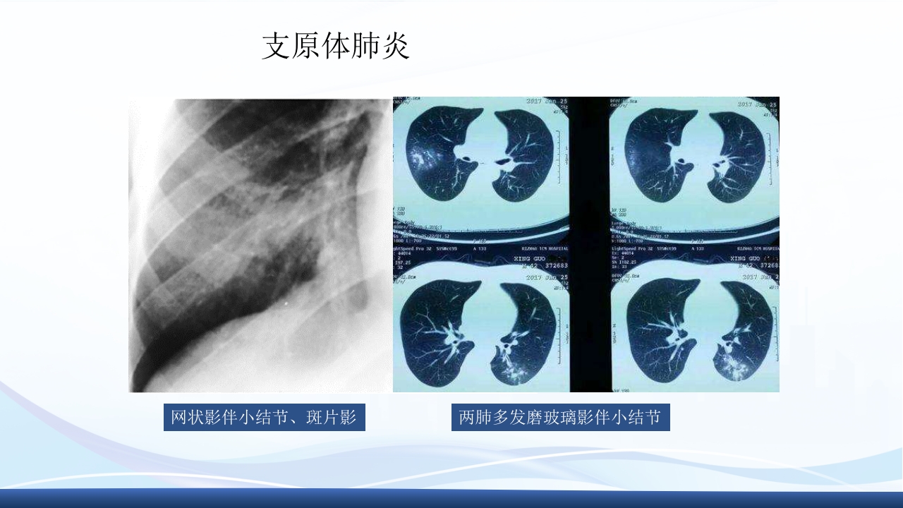 社区获得性肺炎教学查房PPT课件35