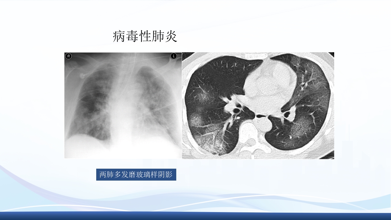 社区获得性肺炎教学查房PPT课件36