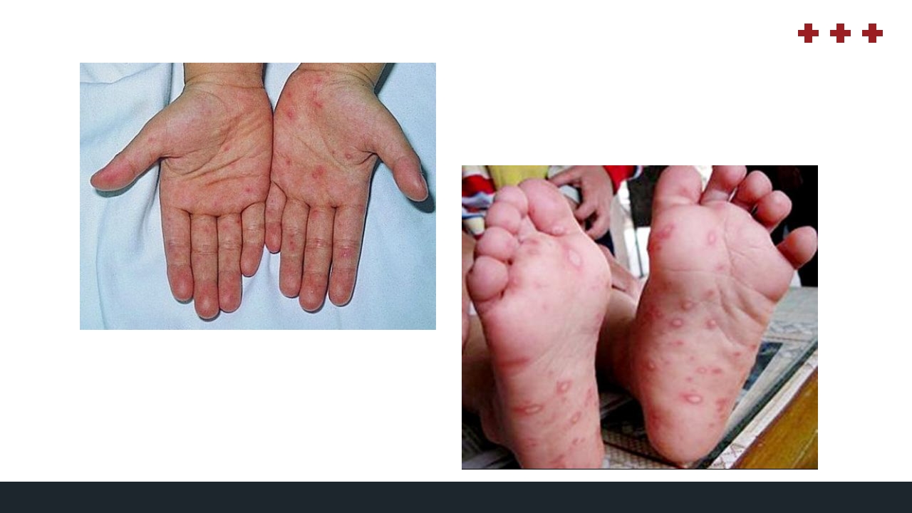 PICU儿童重症监护PPT课件34