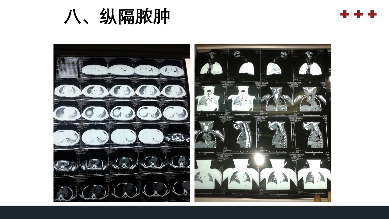 PICU儿童重症监护PPT课件41