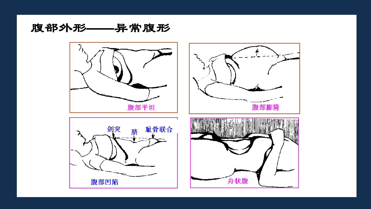 腹部体格检查及腹腔穿刺术PPT课件13