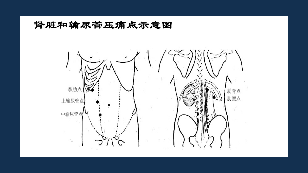 腹部体格检查及腹腔穿刺术PPT课件29