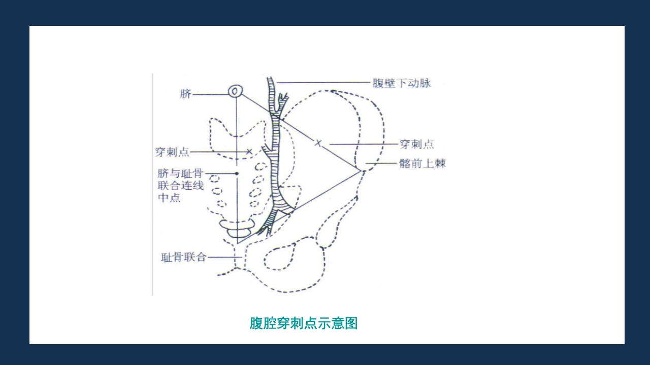 腹部体格检查及腹腔穿刺术PPT课件75