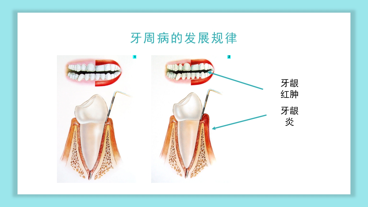 口腔健康知识讲座PPT课件20