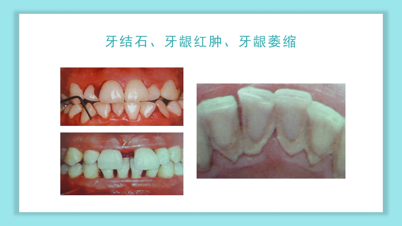 口腔健康知识讲座PPT课件22