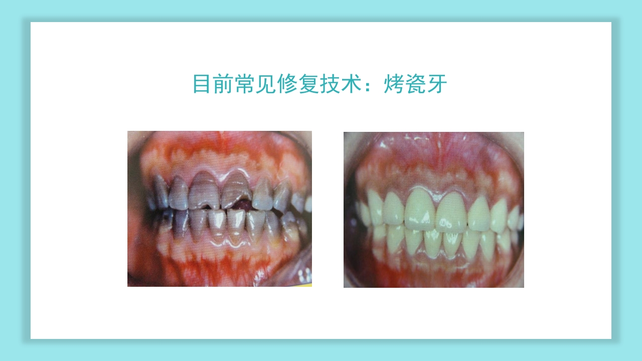 口腔健康知识讲座PPT课件27