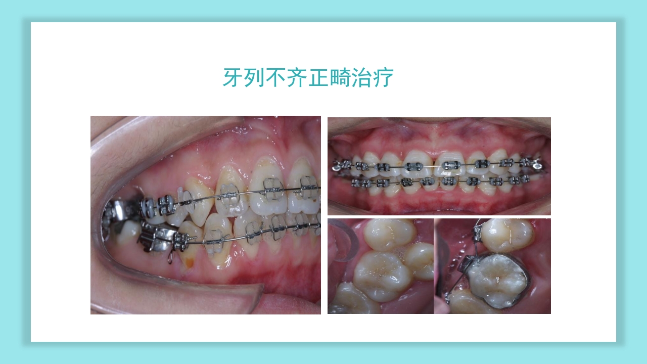 口腔健康知识讲座PPT课件28