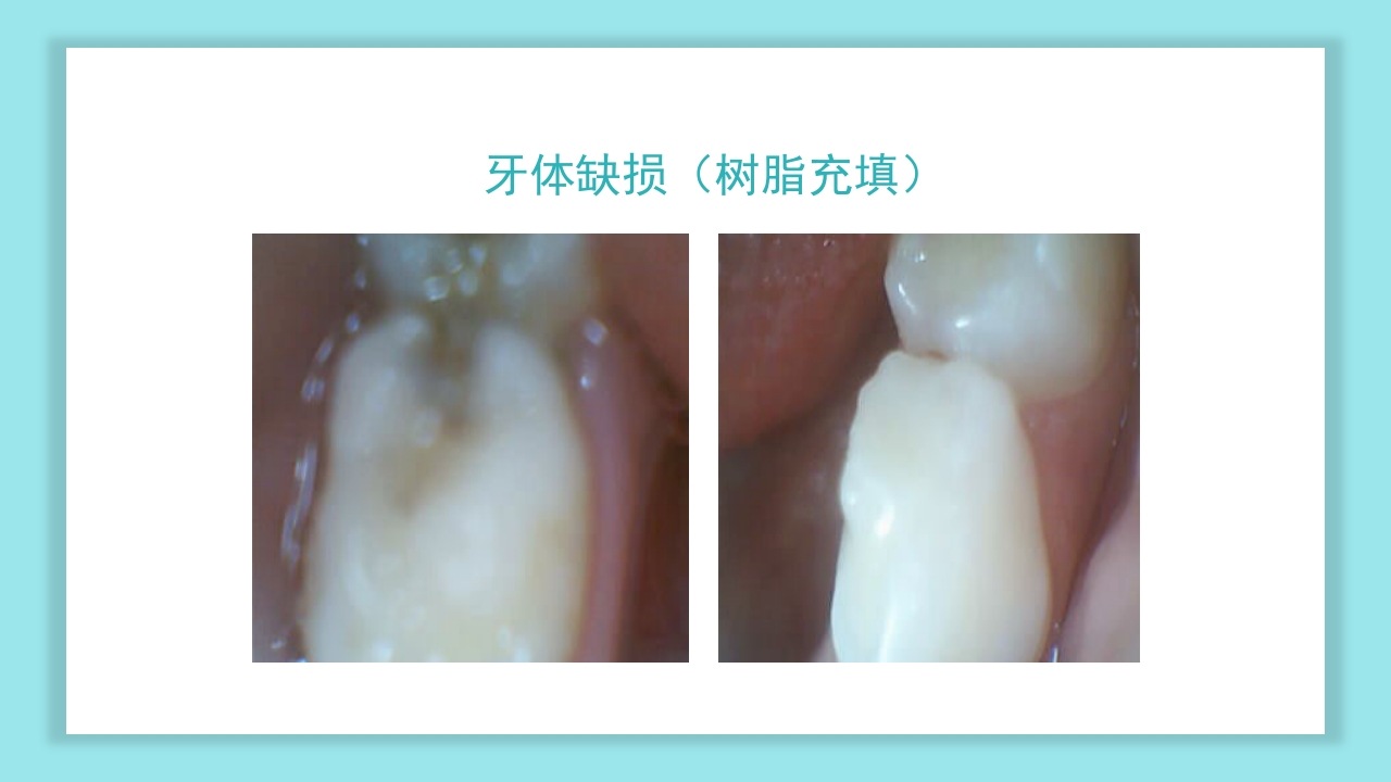 口腔健康知识讲座PPT课件30