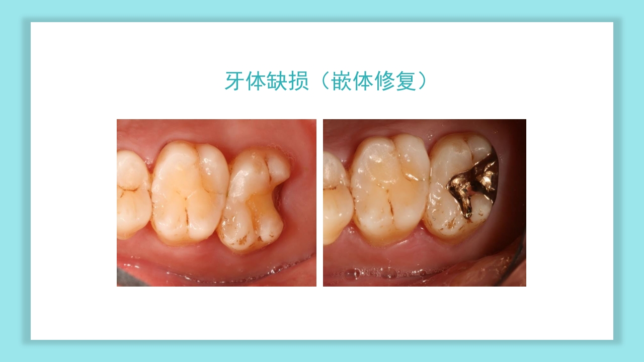 口腔健康知识讲座PPT课件31