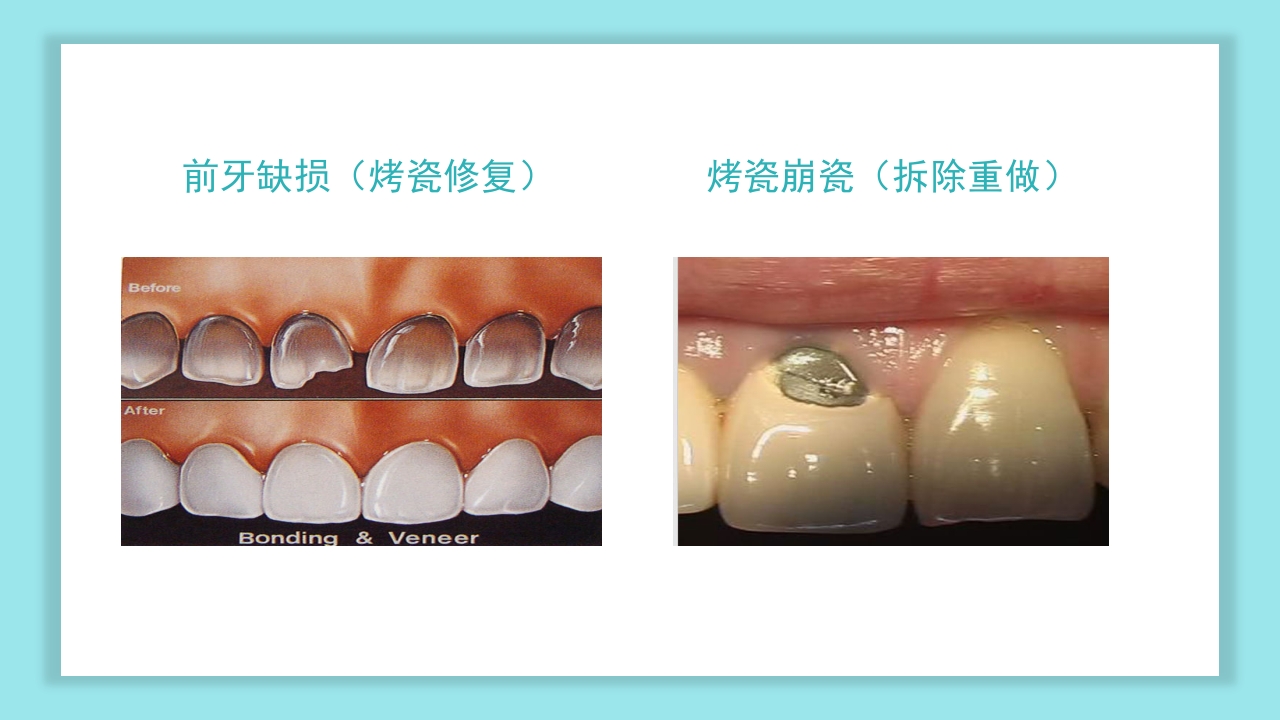 口腔健康知识讲座PPT课件32