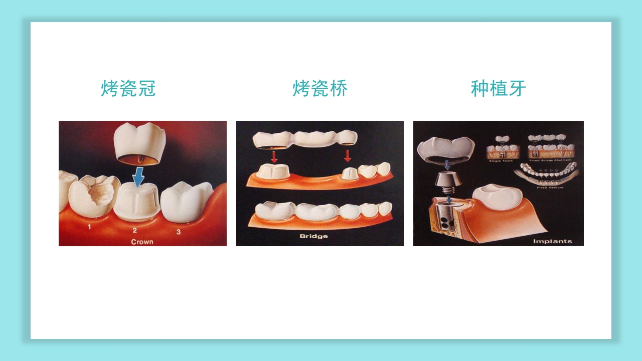 口腔健康知识讲座PPT课件34