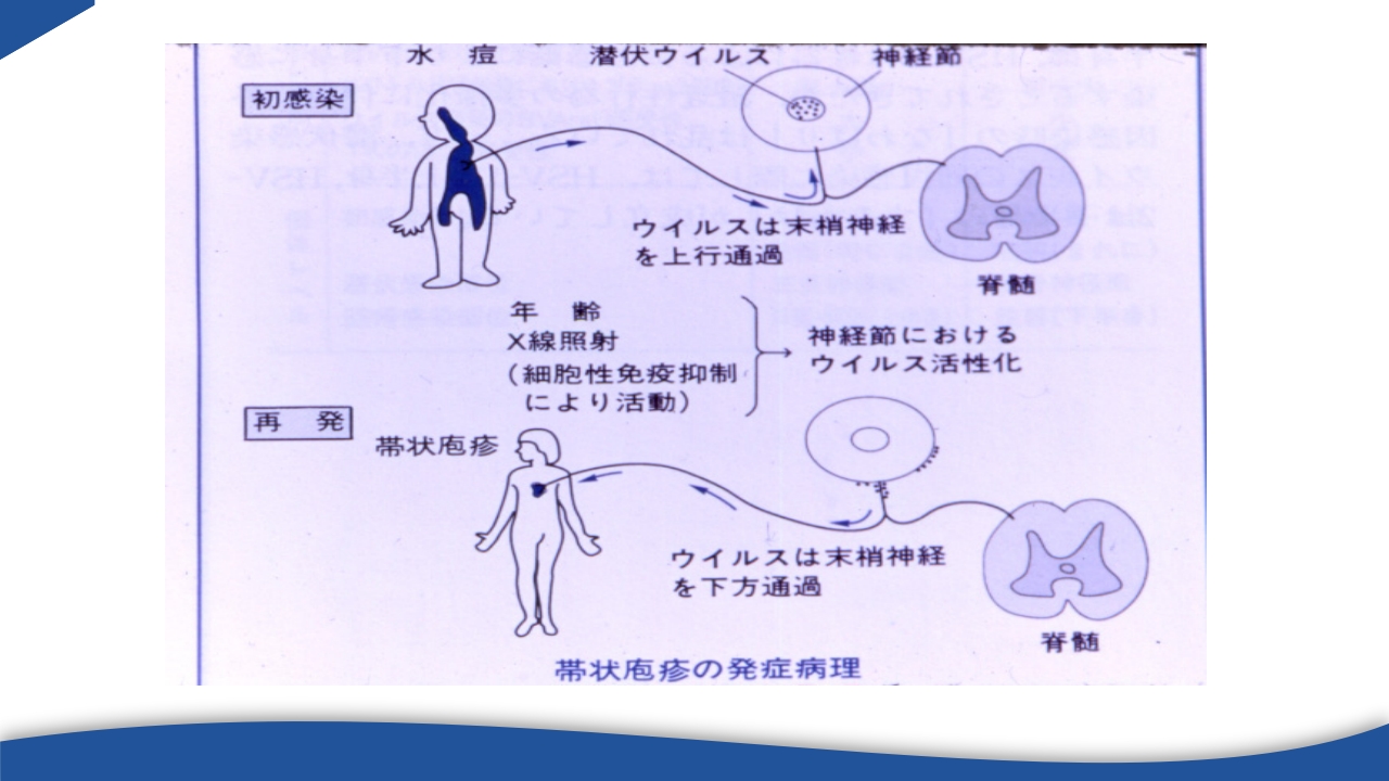 带状疱疹教学PPT课件13