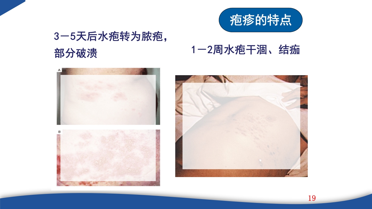 带状疱疹教学PPT课件19